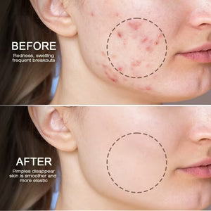 Sumifun - Bee Venom Anti-Acne Gel